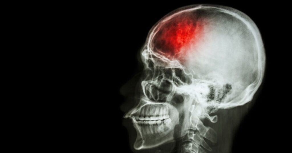 Sintomas de AVC: como reconhecer sinais de alerta